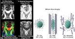 FIGURE 31.5. The images on the left show the comparison T1- and T2-weighted imaging sequence cropped at the level of the anterior corpus callosum (forceps minor) compared with the DTI sequence (upper left) and diffusion color map that reflects directionality of tracts (blue: vertically oriented tracts, green: anteroposterior oriented tracts, red-orange: laterally, side-to-side oriented tracts).