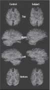 FIGURE 31.6. DTI tractography is shown in a control subject age-matched to a TBI case with severe injury showing the loss of tracts throughout the brain regardless of perspective.