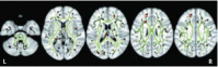 FIGURE 31.7. Tract-based spatial statistics analysis of the white matter skeleton.