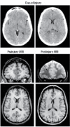 FIGURE 31.15. This young adult sustained a significant mTBI in an auto-pedestrian injury where she had positive LOC, but the DOI CT revealed no abnormality.