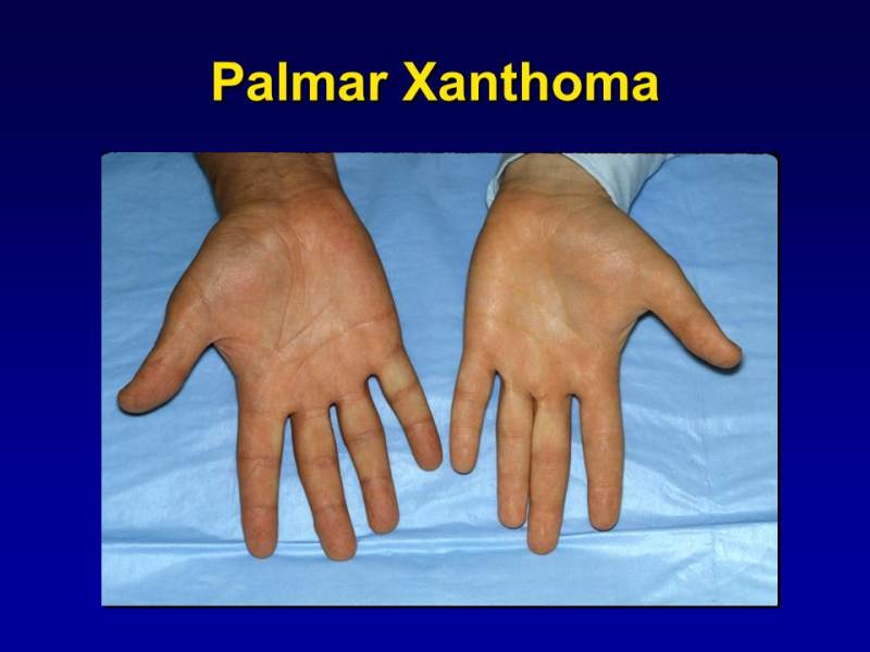 Figure 1. . Palmar Xanthomas: Orange-yellow discoloration confined to the palmar creases.