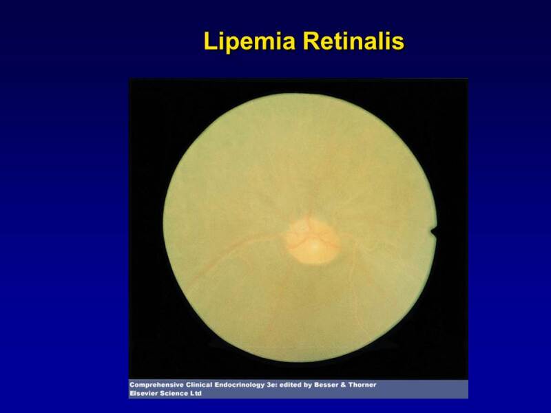 Figure 3. . Lipemia retinalis.
