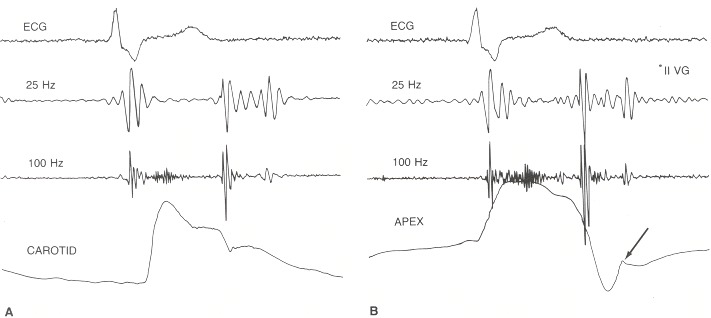 Figure 24.1. Four-channel phonocardiogram taken at a paper speed of 100 mm/sec.