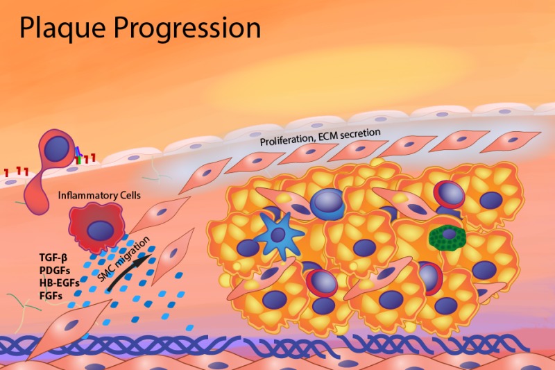 Figure 3. . Progression of the atherosclerotic plaque.
