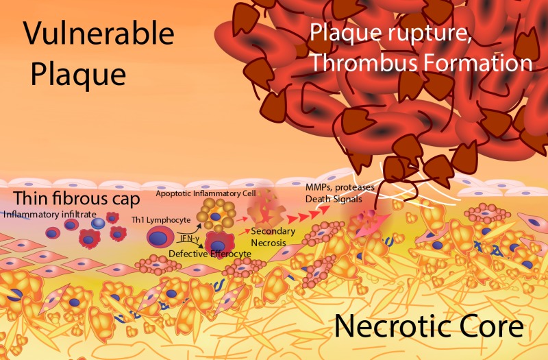 Figure 5. . Formation of the vulnerable plaque.