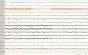  24. ábra... Folyamatos újszülöttkori EEG.