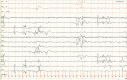 Abbildung 29... Neonatales EEG: Asynchronie.