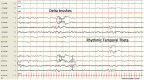 Abbildung 34. Zentrale Delta-Bürsten, rechtes rhythmisches temporales Theta.