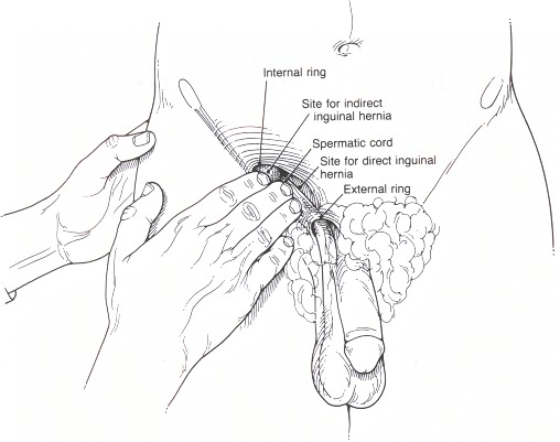 Figure 80.15. Direct compression of the inguinal region to determine site of herniation.