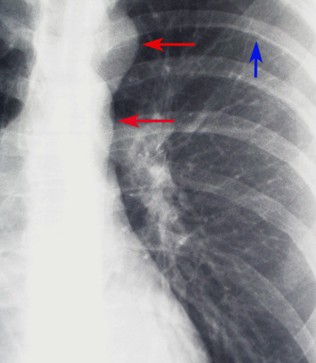 Figure X Ray Cardiac Coarctation Of The Aorta Close Up Contributed
