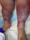 Understanding Venous Insufficiency: Causes, Symptoms, and Management -  Longmore Clinic