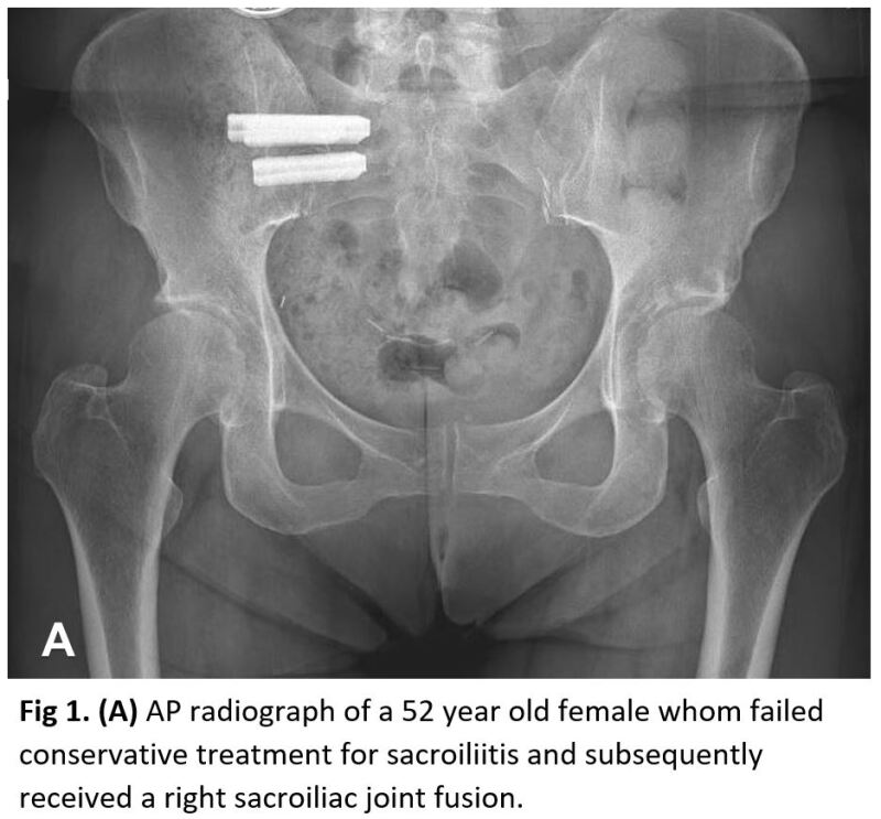 Figure, Radiograph, Sacroiliitis, Right Sacroiliac Joint Fusion. Contributed by StatPearls] - StatPearls - NCBI