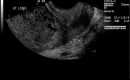 Uterus Ultrasound, Molar Pregnancy