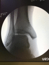 Acute Ankle Sprain Deltoid and syndesmotic insufficiency demonstrated by medial gutter widening