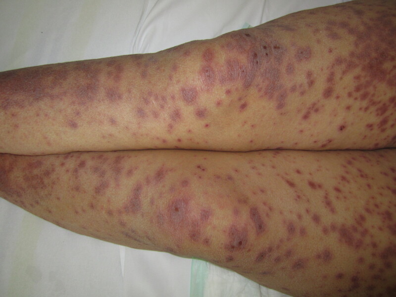 Figure Erythematous Purpuric Macules Targetoid Lesions Statpearls Ncbi Bookshelf