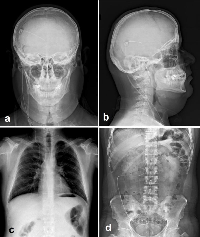 Shunt series, Radiology Reference Article