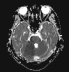 MRI Finding of Cerebellar Infarction