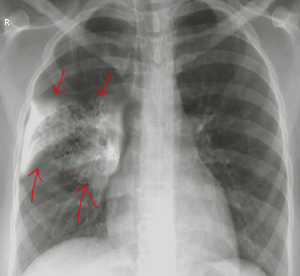Aspiration pneumonia, Radiology Reference Article
