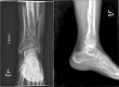 AP and lateral XR of left pilon fracture Contributed by T