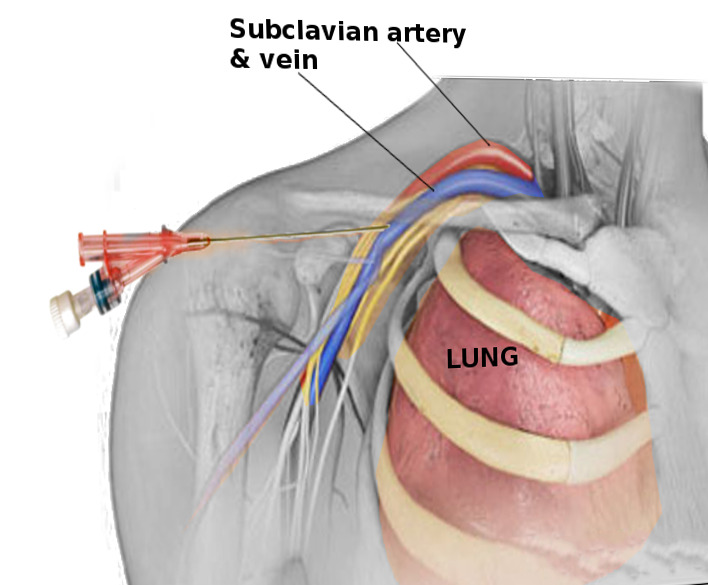 Central Venous Catheter Subclavian