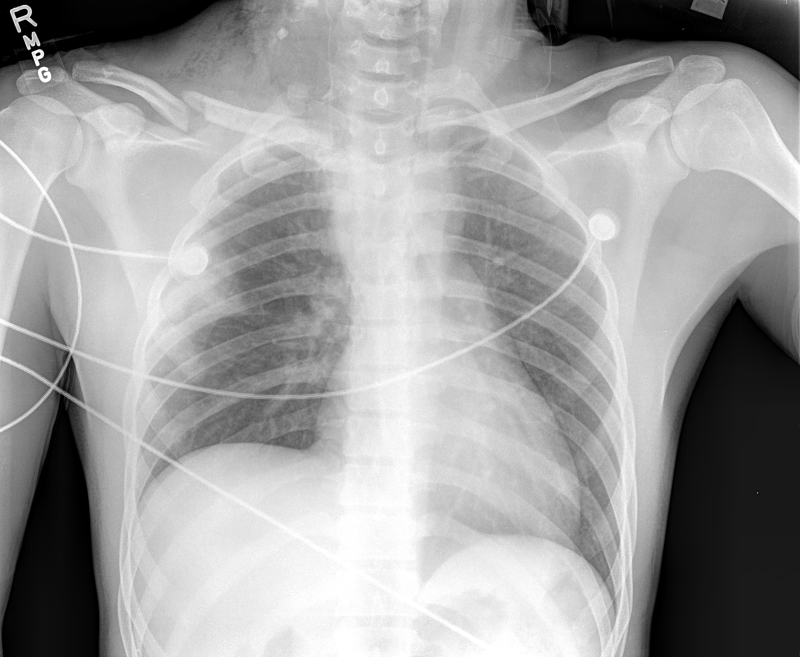 Figure Chest X Ray Of A Patient Statpearls Ncbi Bookshelf