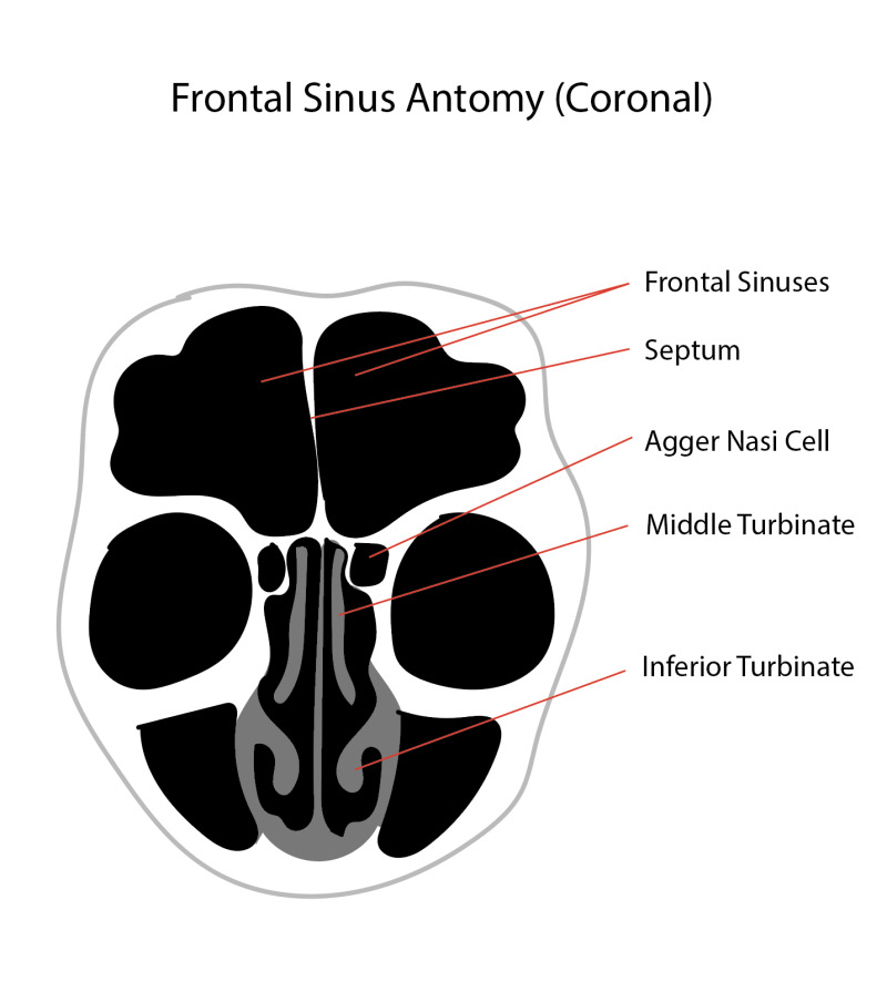 Diagram of the frontal sinus anatomy, coronal view