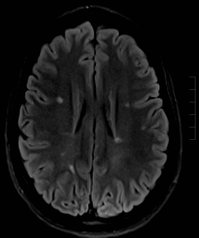 Figure Multiple Sclerosis Contributed By Sunil Munakomi Md