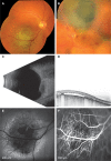 Figure 1. Fundus appearance of a small dome-shaped tumor with orange pigment (A) and of a larger, bi-lobed “mushroom-like” tumor with exudative retinal detachment (B).