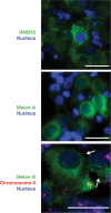 Figure 2. Immunohistology of a tumor biopsy disclosing HMB-45- (upper) and Melan-A- (middle) positive cells and Immuno-FISH for chromosome 3 (lower).