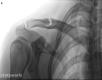 Clavicle fracture Image courtesy O