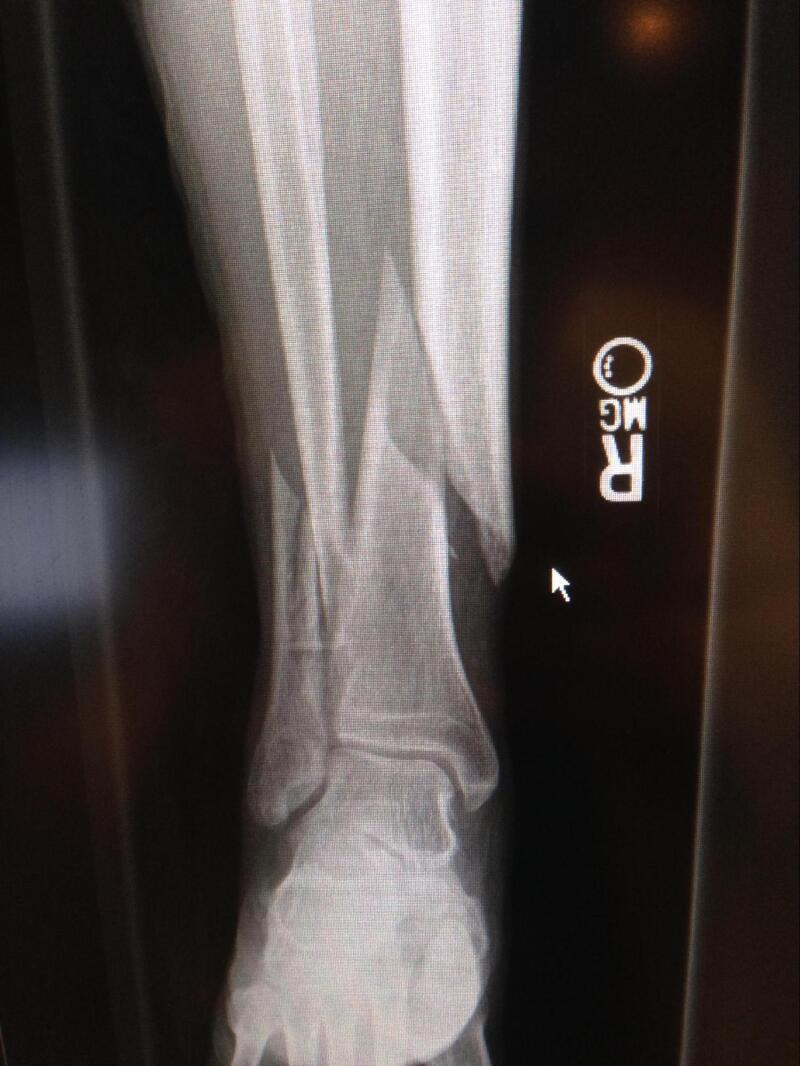 Figure Tibial Fracture Spiral Fracture Of The Distal One Third Tibia