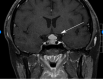  Pituitary Hyperplasia