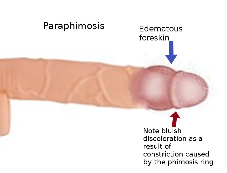 Figure 1 from Pathologic and physiologic phimosis: approach to the phimotic  foreskin.