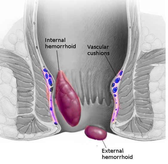 Meaning hemorrhoids Why Do