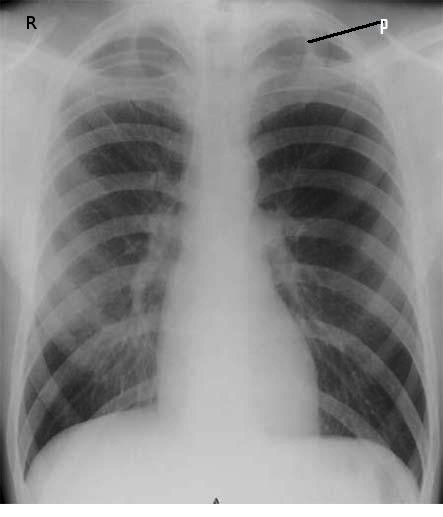 Figure Apical Ptx Primary Spontaneous Pneumothorax X Ray