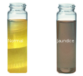 figure normal urine color versus jaundicetea colored urine