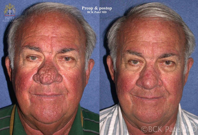 58-year-old gentleman undersent scalpel resection of the rhinophyma and immediate CO2 laser resurfacing and shrinkage of the surrounding tissues with healing by secondary intention