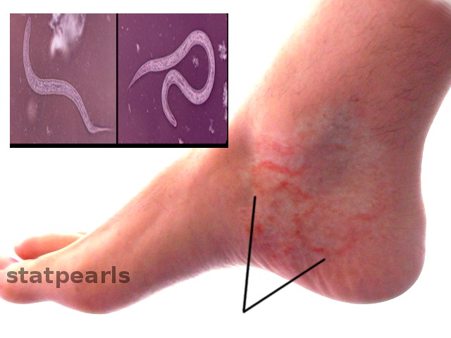 Figure, Hookworm infection Image courtesy O.Chaigasame] - StatPearls - NCBI  Bookshelf