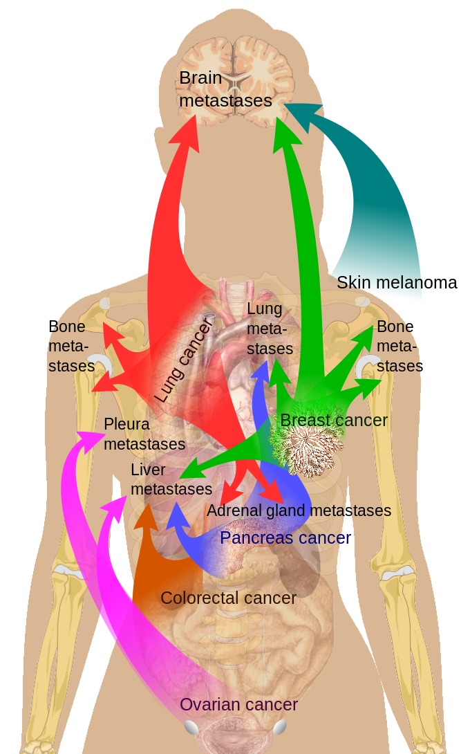 rectal cancer ncbi)