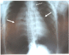 Chest X-ray With Bilateral Pneumothoraces Morgan Le Guen, Catherine Beigelman, Belaid Bouhemad, Yang Wenjïe, Frederic Marmion, Public Domain, via Wickipedia