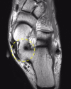 tratament articular subtalar)