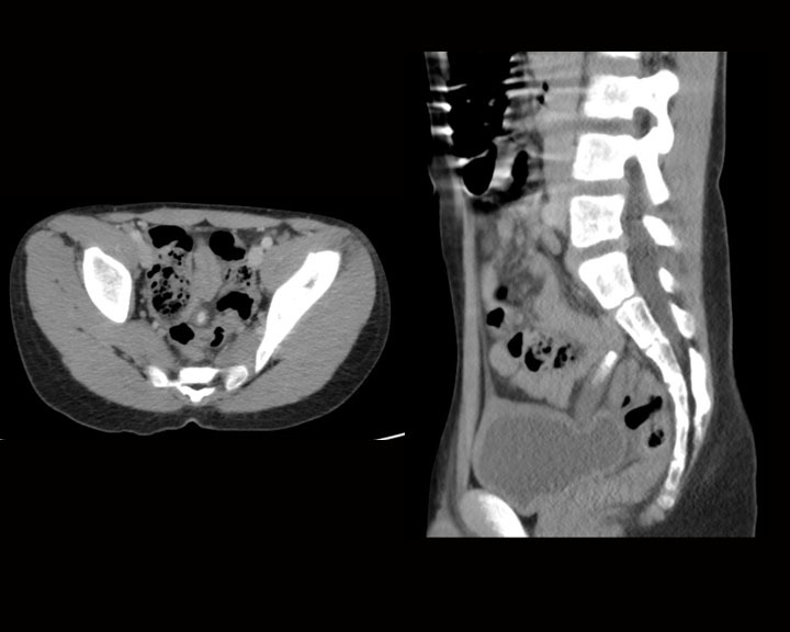 Figure Early Acute Appendicitis With The Statpearls Ncbi