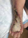Non-viable split-thickness skin graft to right dorsal hand and wrist