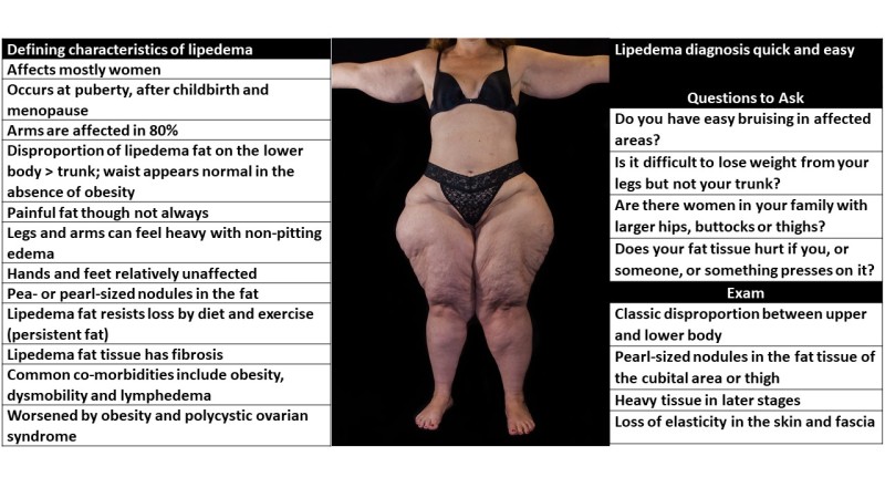 Figure 1. . Characteristics of lipedema that aid in establishment of diagnosis are listed, and many can be seen in the accompanying photo.