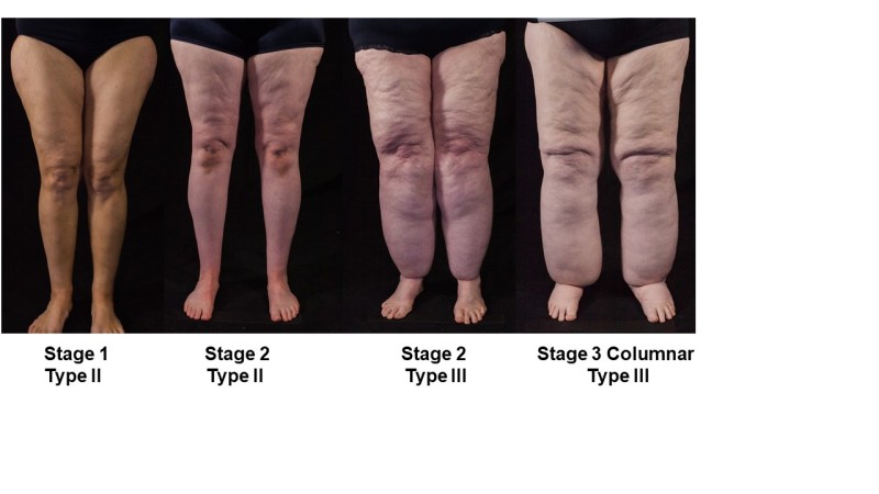 Figure 2. . Three stages of legs of women with lipedema with subcategories of types.
