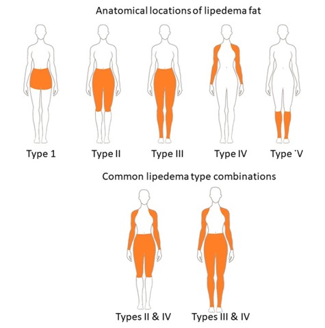 Figure 3. . Types of lipedema fat.
