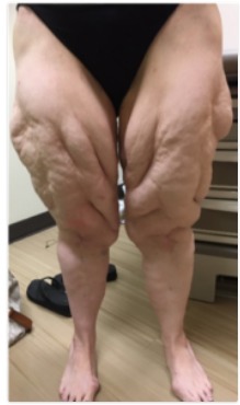 Subcutaneous Adipose Tissue Diseases: Dercum Disease, Lipedema