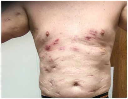 Figure 5. . Multiple scars after excision of lipomas in FML.