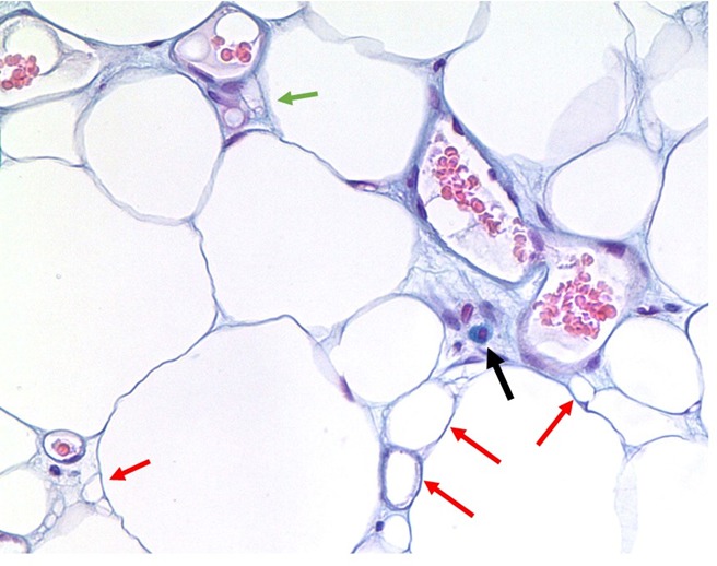 Figure 6. . Angiolipoma with mast cell with enlarged multiple vessel lumens and degraded tissue.