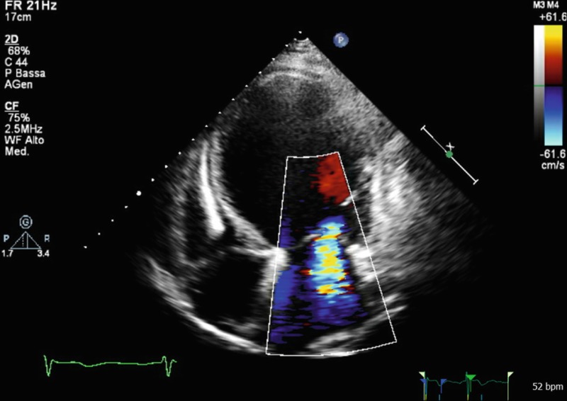 Role of Cardiac Imaging: Echocardiography - Dilated Cardiomyopathy ...